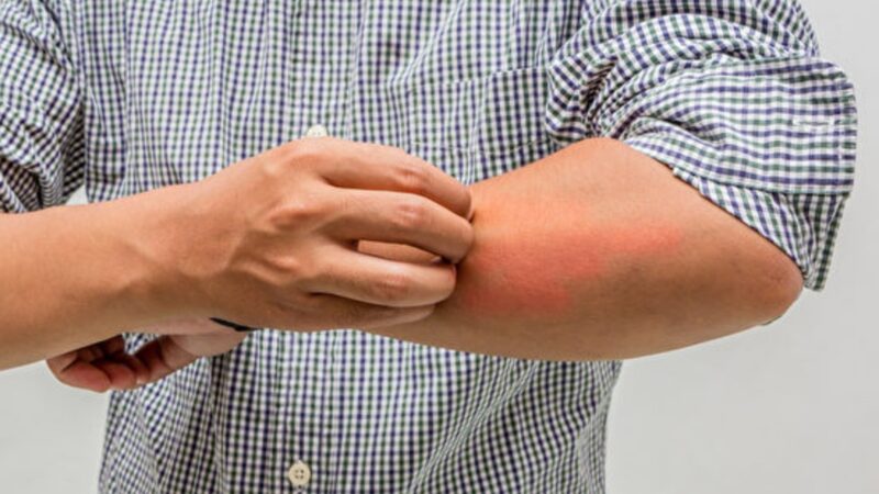 疥疮堪称“最痒皮肤病”传染力强 5招预防