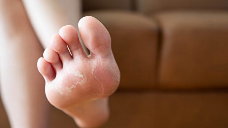 腳出汗不一定腳臭！腳臭常見原因 3方法除臭