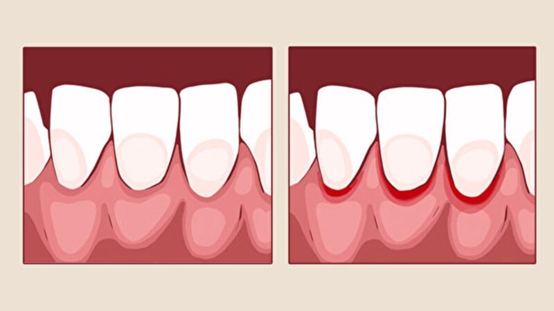別讓牙齒走不歸路 牙齦發炎8大原因及改善方法