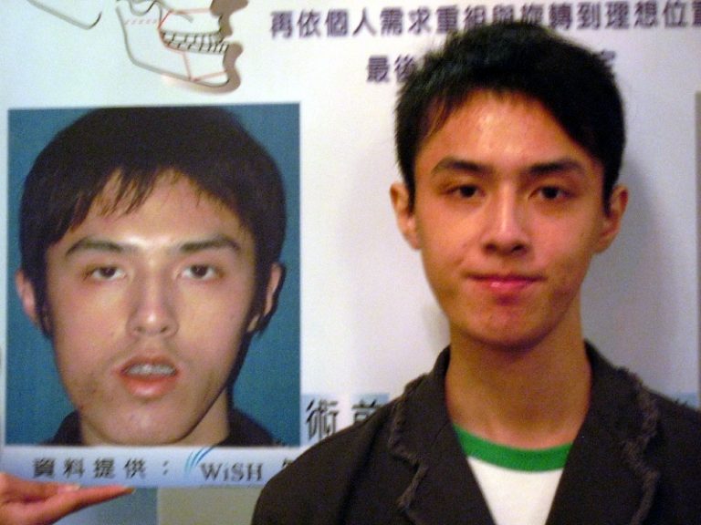聽障青年下顎發育過多臉歪斜  正顎拾信心