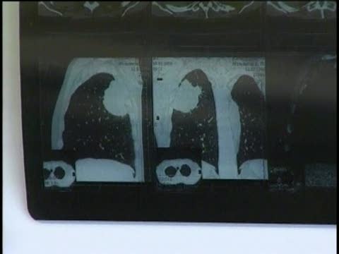 俄一男子肺里長出5厘米高杉樹