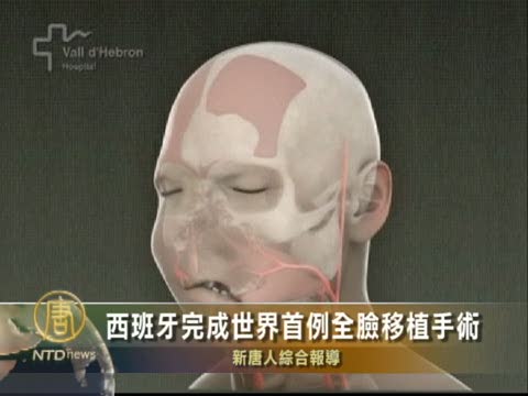 西班牙完成世界首例全臉移植手術