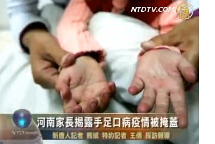河南家長揭露手足口病疫情被掩蓋