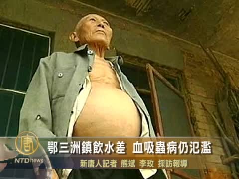 鄂三洲鎮飲水差 血吸蟲病仍氾濫