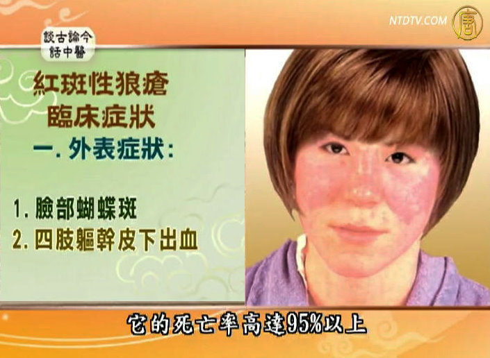 談古論今話中醫：告別紅斑性狼瘡