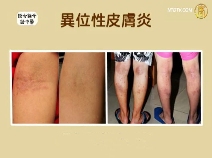 談古論今話中醫：異位性皮膚炎