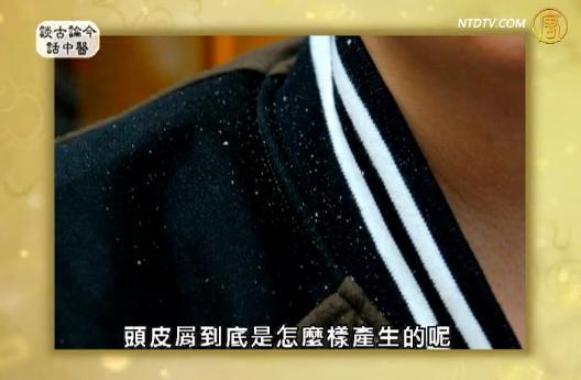 談古論今話中醫：頭皮屑紛飛真煩惱