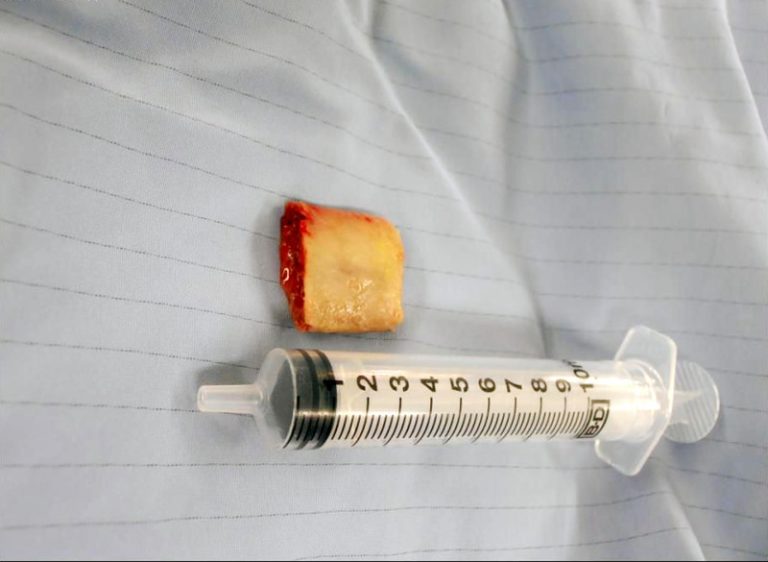 硬骨頭卡食道  罹吸入性肺炎
