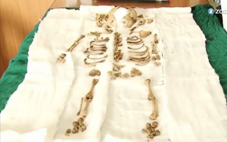 宮外孕36年 印度老婦腹中足月胎兒變骨骸