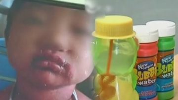 泡泡水強腐蝕 4歲童玩後渾身蛻皮嘴潰爛