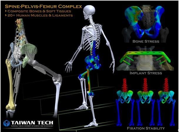 电脑分析骨盆手术效果 台科大夺ANSYS冠军