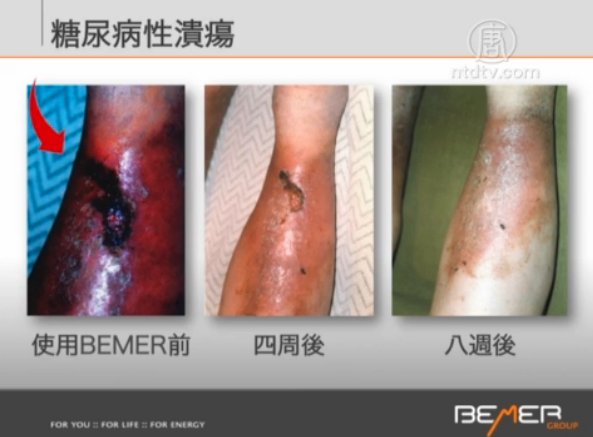 生活百分百：BEMER理療儀對糖尿病的作用