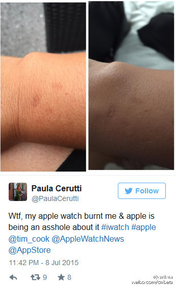 曝Apple Watch過熱 致皮膚灼燒