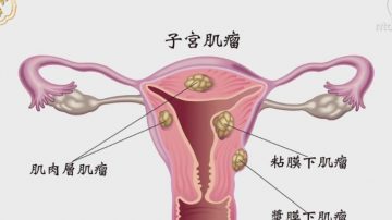 談古論今話中醫：認識子宮肌瘤