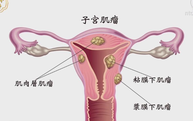 談古論今話中醫：認識子宮肌瘤
