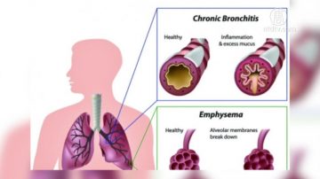 慢阻肺是美國第3大殺手 預防診斷為重