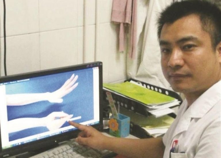喝蛇酒治風濕痛　江蘇女雙手險致殘