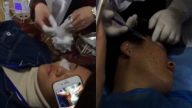 大陸整形恐怖內幕  雞腿練割雙眼皮  10天速成美容師