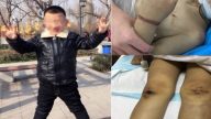 陆虐童案频发 陕男童遭继母电线绑手撞墙命危