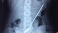 浙江女孩誤吞20公分長鋼杓   3天後才覺不舒服