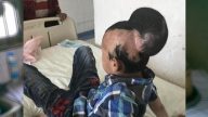 1歲摔在爐台 11歲男孩陰陽頭變大小頭