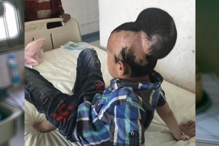1歲摔在爐台 11歲男孩陰陽頭變大小頭