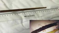 打赌吞筷子30年留体内  湖北男十二指肠溃疡