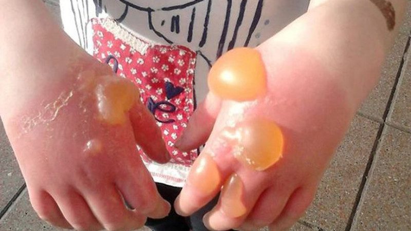 劇毒草英國瘋蔓延 10歲童觸摸 手起大水泡