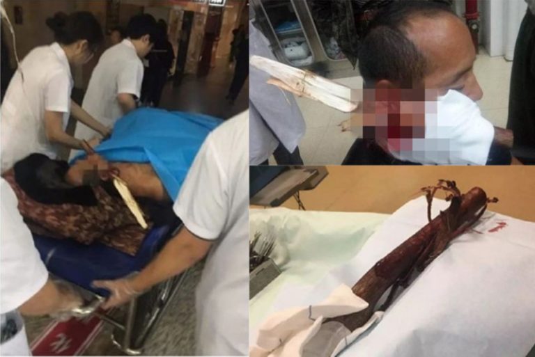 命大！吉林男子採松子摔落 手腕粗樹杈穿透臉頰