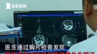 惊人！湖北男拔火罐 右肺竟离奇“消失”