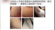 沧州红黄蓝幼园再曝针扎虐童  家长约带菜刀掌掴教师
