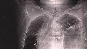 杭州男腸子移位至頸項位置 幾十年忍痛不察
