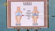 談古論今話中醫：獨家中醫秘方 拯救退化性關節炎