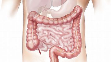 腸道發炎、腸躁症 腸胃醫師教你5招保腸（視頻）