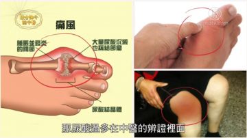 談古論今話中醫：「痛風」痛得受不了 中醫有法寶