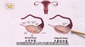 談古論今話中醫：多囊性卵巢症候群 中醫療法