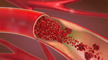 研究者找到治療動脈硬化潛在方法