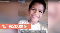 男童长了300多颗牙 患有罕见病症却不向命运低头的小孩（视频）