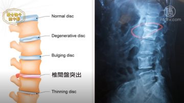 谈古论今话中医：坐骨神经痛 中医疗法