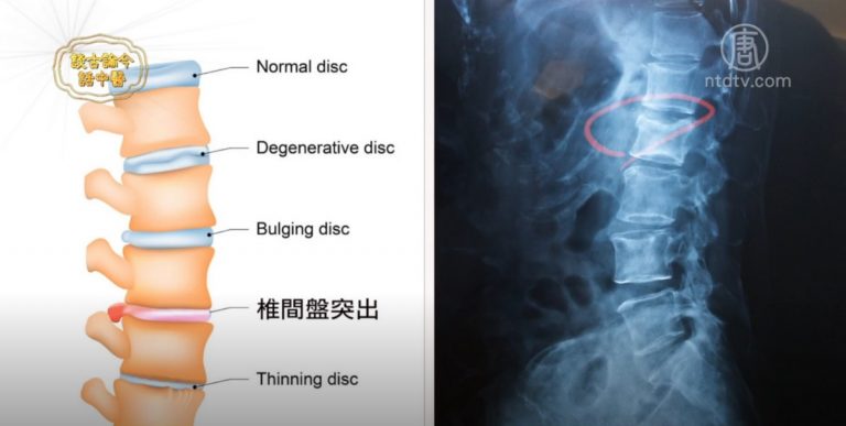 談古論今話中醫：坐骨神經痛 中醫療法