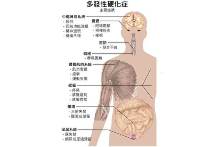 新方法可預防和逆轉多發性硬化症