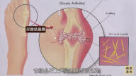 談古論今話中醫：痛風