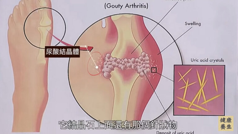 談古論今話中醫：痛風