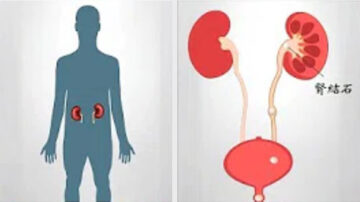 談古論今話中醫：腎結石