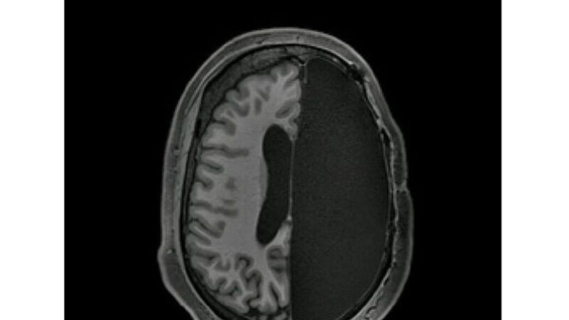 半个大脑仍正常工作 启发脑损伤治疗