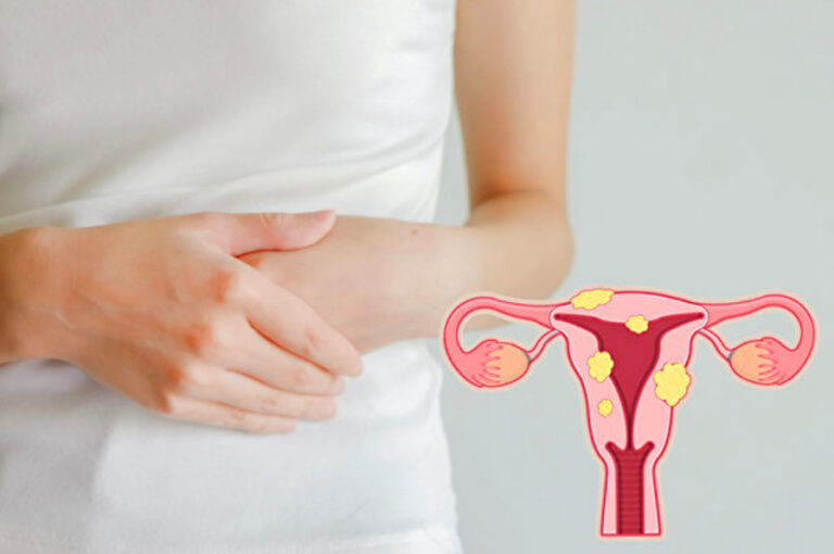 遠離婦科腫瘤 中醫流傳至今的女性養生良方