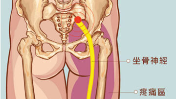 預防坐骨神經痛 中醫師教按摩三穴道（組圖）