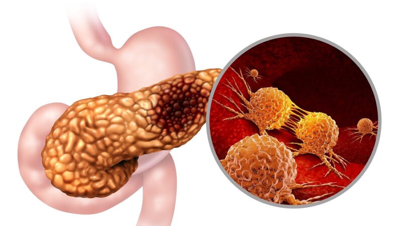 科学家发现最常见胰腺癌成因