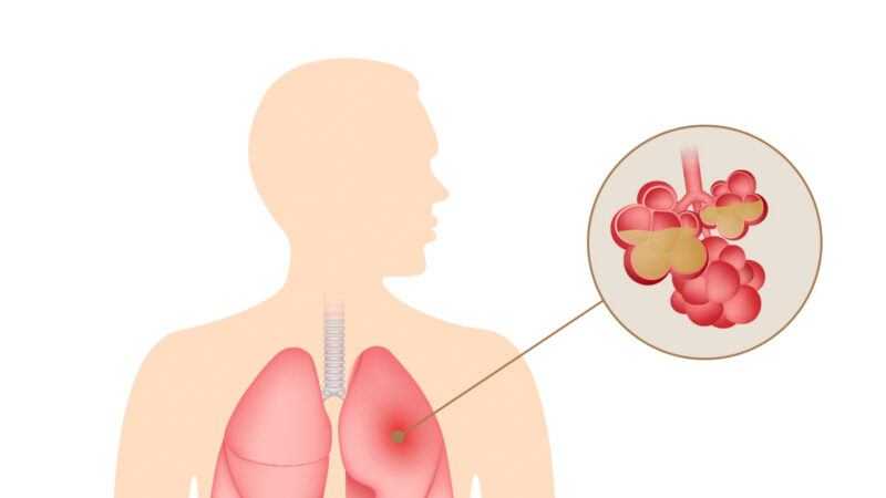 不只是咳嗽和发烧 肺炎的突出症状有哪些？（组图）