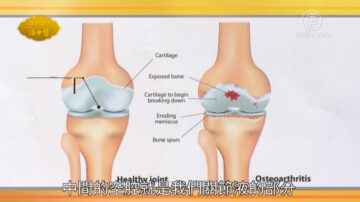 談古論今話中醫：退化性關節炎